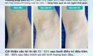 Dr. Choice Clinic trị thâm nách/bẹn có hiệu quả tốt? 2
