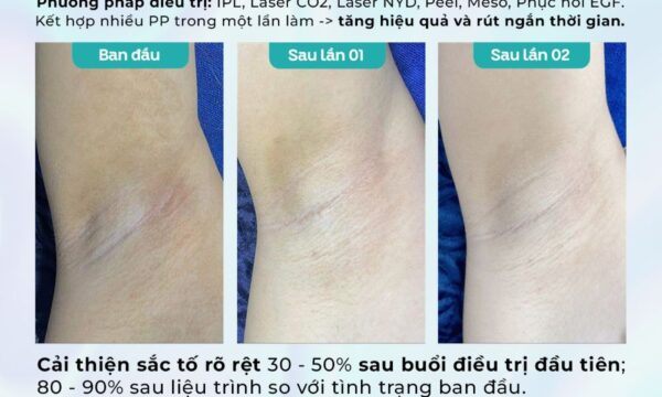 Dr. Choice Clinic trị thâm nách/bẹn có hiệu quả tốt? 9 Dr. Choice Clinic trị thâm nách/bẹn có hiệu quả tốt? 6
