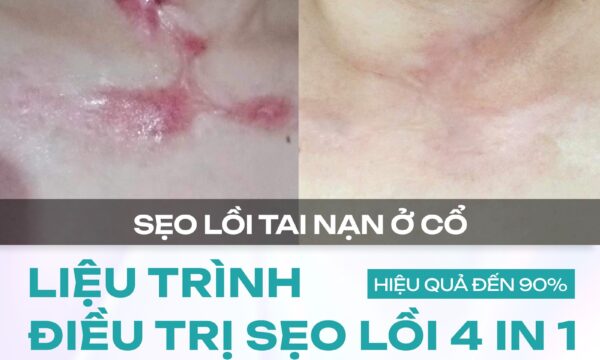 Đánh giá hiệu quả điều trị sẹo lồi tại Dr. Choice Clinic: Có nên thử? 11 Đánh giá hiệu quả điều trị sẹo lồi tại Dr. Choice Clinic: Có nên thử? 8